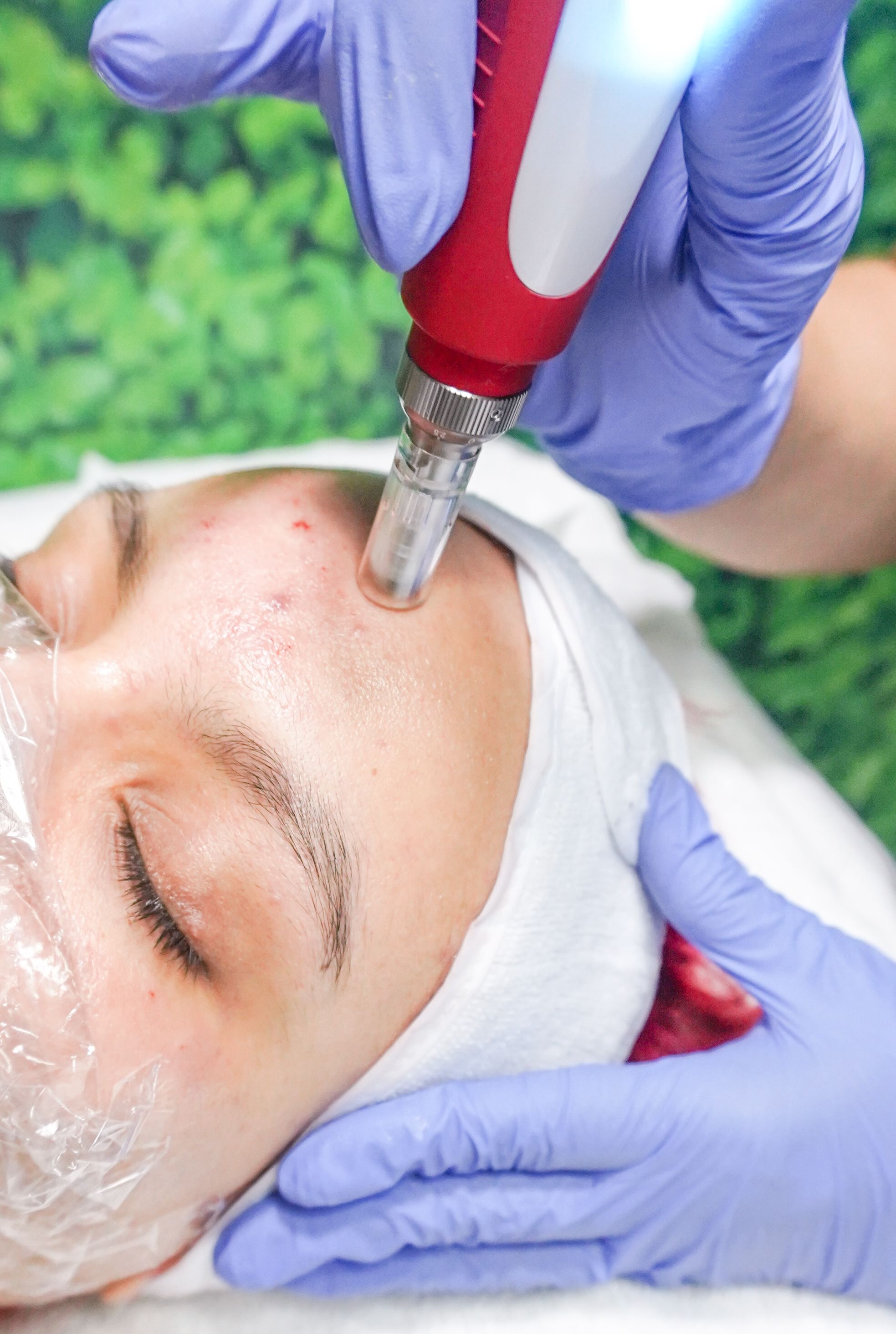 Microneedling treatment session