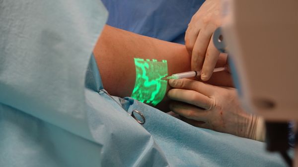 Sclerotherapy leg vein treatment at Aurevia Skincare Irvine